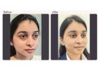 Eyelid surgery in Delhi - Dr Rajat Gupta