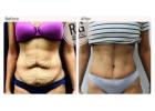 Tummy Tuck Surgery cost in Delhi - Dr Rajat Gupta