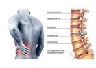 Herniated disc treatment Fenton