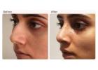 Rhinoplasty Surgery in Delhi - Dr Rajat Gupta