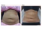 Liposuction Surgery Cost in Delhi - Dr Rajat Gupta
