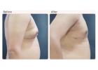 Gynecomastia Surgery Cost in Delhi - Dr Rajat Gupta
