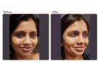 Dimple Creation Surgery Cost in Delhi - Dr Rajat Gupta New Delhi