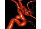 Best Neurosurgeon for Brain Aneurysm Treatment in Surat