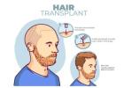 Natural Hair Restoration Solutions in Santa Monica & Beverly Hills