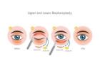 Eyelid surgery cost in Delhi - Dr Rajat Gupta