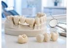 Durable Dental Crowns and Bridges for Missing or Damaged Teeth