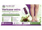 Effective Varicose Veins Treatment in Ayurveda for Natural Relief