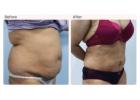 Breast reconstruction surgery in Delhi - Dr Rajat Gupta