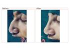Nose surgery cost in Delhi - Dr Rajat Gupta
