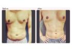 Liposuction Surgeon in Delhi - Dr Rajat Gupta