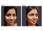 Dimple Creation Surgery in Delhi - Dr Rajat Gupta