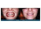Porcelain Veneers Melbourne Can Transform Your Appearance