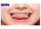 Invisible Braces: Your Path to a Subtle Smile Transformation