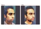 Chin Augmentation in Delhi - Dr Rajat Gupta