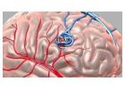 Exploring Modern Aneurysm Brain Surgery Options?