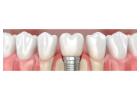 Get your natural look with metal-free Dental crowns in Tijuana from Teeth Savers