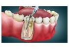Root Canal Cost in Thane | Agrawal Dental Clinic
