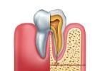 Root Canal Treatment for Pain Relief and a Healthy Smile
