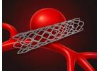 Exploring Coiling Aneurysm Procedure for Better Care?