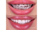 Trusted Orthodontic Services And Sedation Dentistry Somerset for Better Smiles