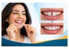 All-on-4 Implants and Invisalign Clear Braces in Brooklyn NY